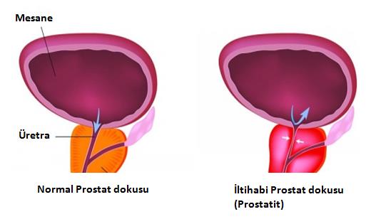 rektális ultrahang vizsgálat Gyertyák antibiotikum a prostatitis címe