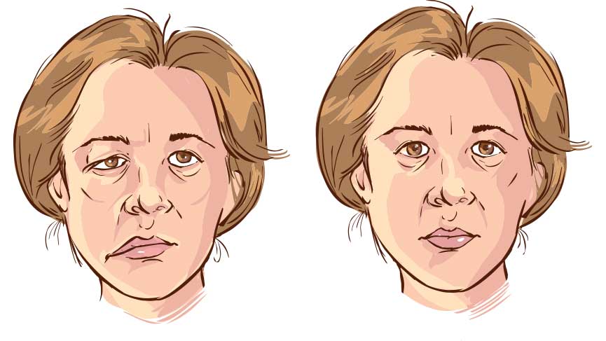 Facial Paralysis Symptoms, Causes & Treatments What causes facial paralysis?