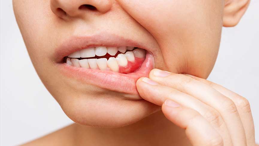 Gingival Recession Treatment Options