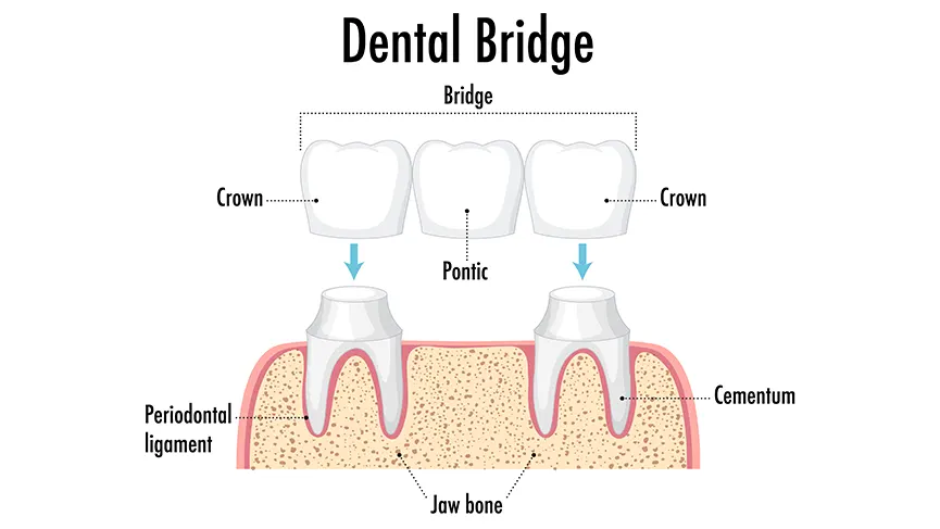 Köprü Diş Nedir? Nasıl Yapılır?
