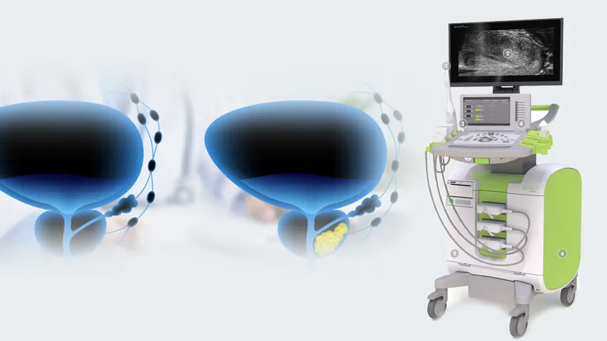 Micro Ultrasound Fusion Biopsy