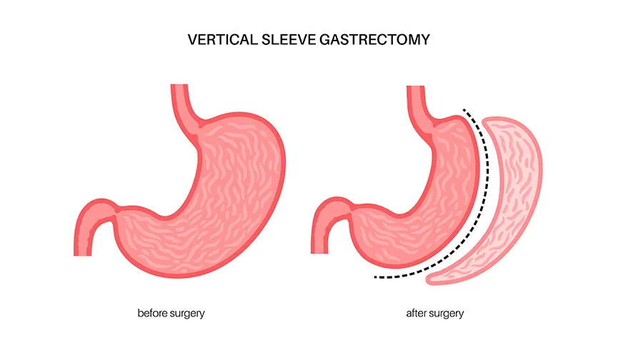 Sleeve Gastrektomi Nedir?