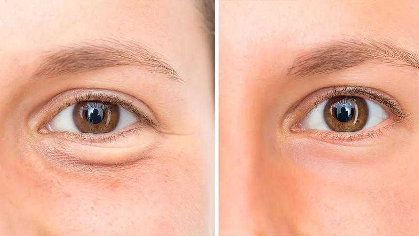 Understanding Cataract Surgery: A Comprehensive Guide to the Procedure