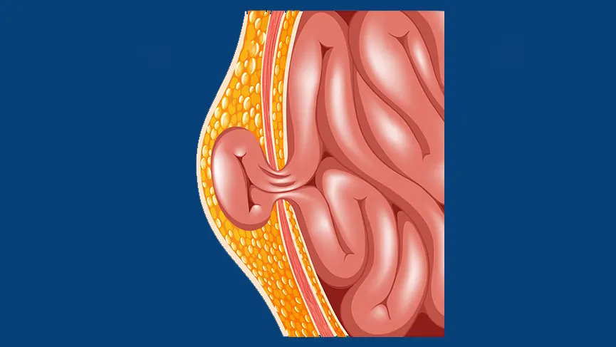 What is an Intestinal Hernia?