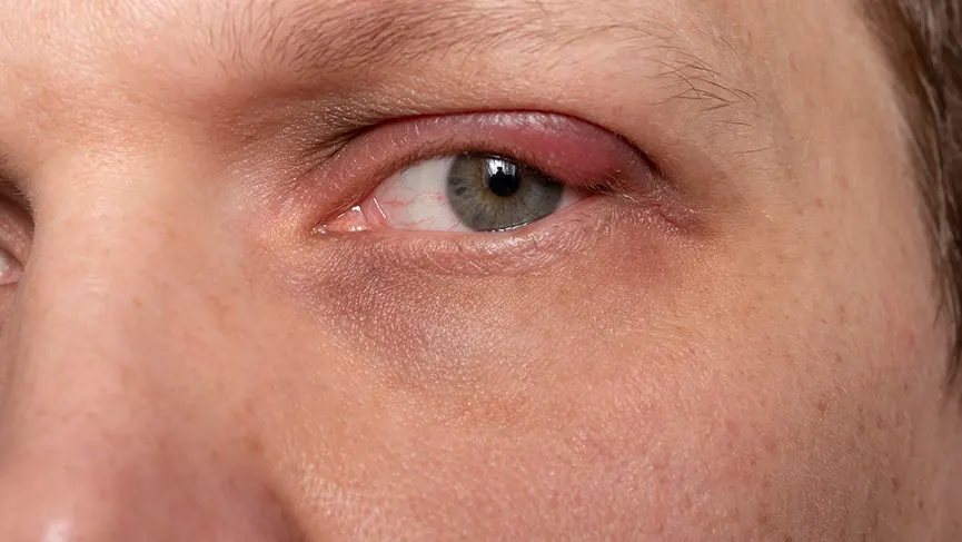 What is Styes? Causes, Types, Symptoms