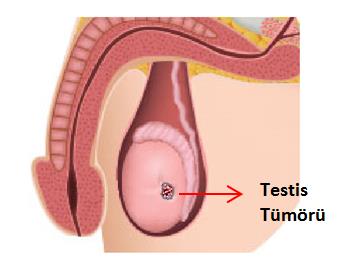 Testis Tümörü