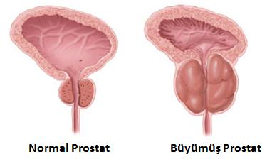 Prostat Büyümesi